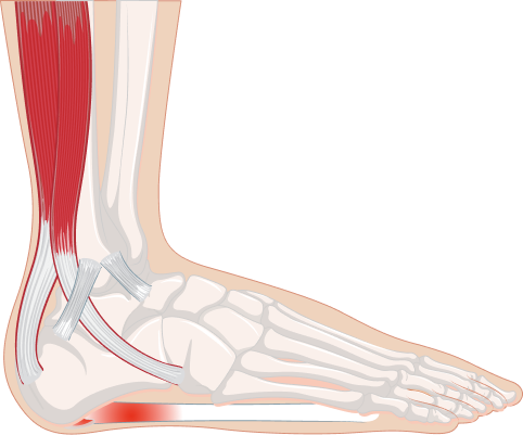 Rappresentazione schematica della fascite plantare