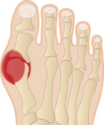 Rappresentazione schematica dell'alluce valgo